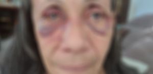 Com marcas de espancamento, mulher suspeita de matar o marido se apresenta à polícia