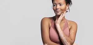 Maquiagem é aliada de mulheres que querem exaltar ou camuflar o vitiligo