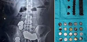 Paciente é operado após engolir 39 moedas e 37 ímãs alegando que 'zinco ajuda na musculação'