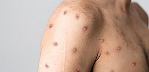 Alagoas confirma 1º caso de Monkeypox, a varíola dos macacos 