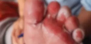 Bebê sofre queimaduras durante banho em creche de SC